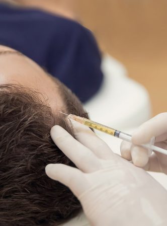 Hair mesotherapy or scalp prp: Platelet-rich plasma procedure. Beautician doctor makes injections in the man head for hair growth against hair loss and baldness