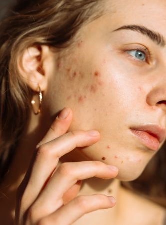 acnescars_recirc-6ec188ea28364201b1d366a39e52154a