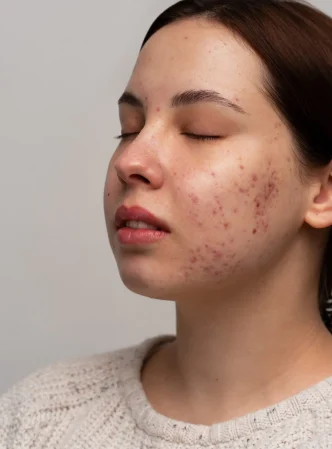 person-dealing-with-rosacea-scaled.jpg